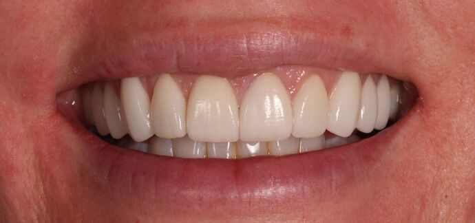 Smile Makeover: Case 3 - After