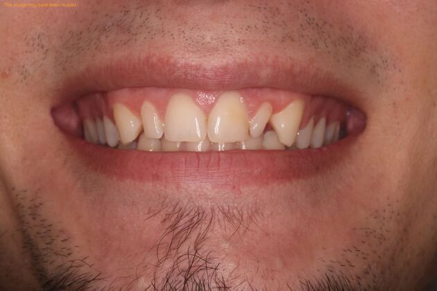 Smile Makeover Case 4 - Before