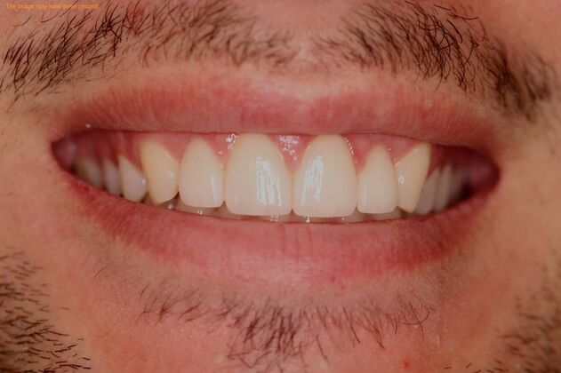 Smile Makeover Case 4 - After