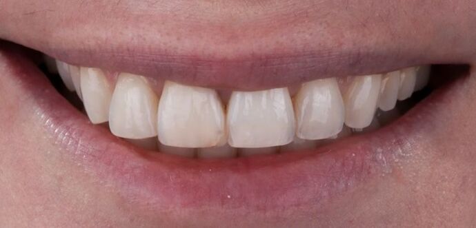 Smile Makeover & Veneers: Tonja - Before