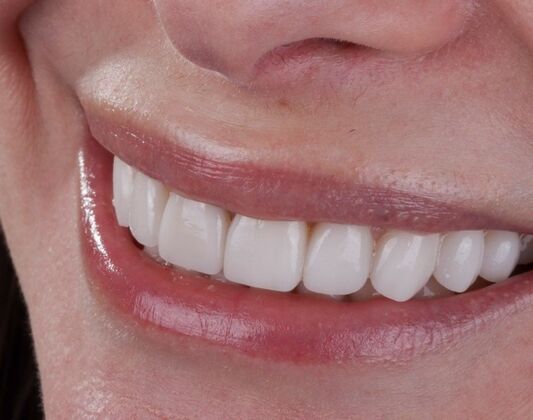 Smile Makeover & Veneers: Tonja