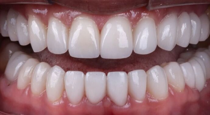 Smile Makeover & Veneers: Bernice - After