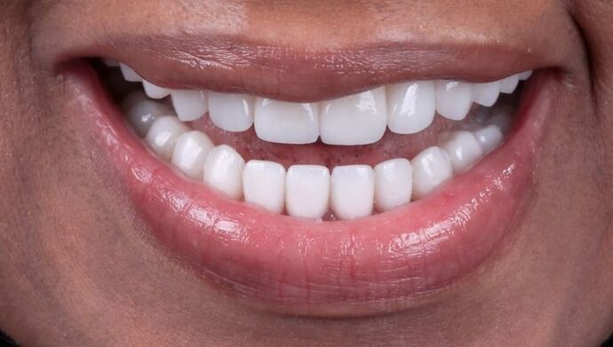 Smile Makeover & Veneers: Bernice - After