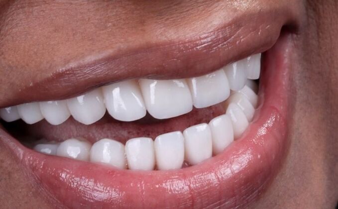 Smile Makeover & Veneers: Bernice - After