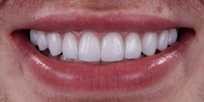 Smile Makeover & Veneers: Connor