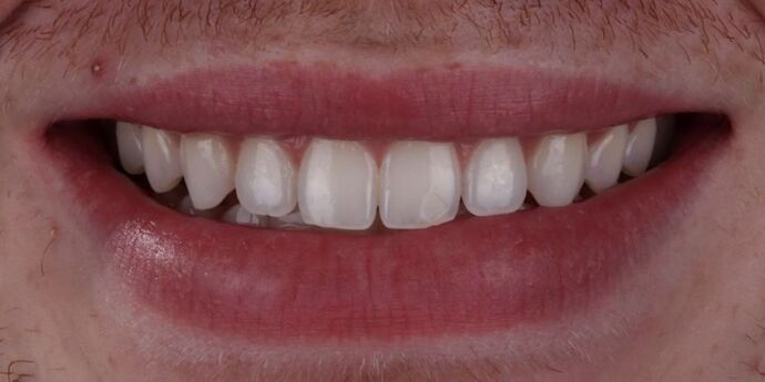Smile Makeover & Veneers: Connor - Before
