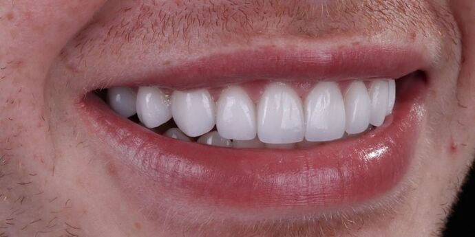 Smile Makeover & Veneers: Connor - Before