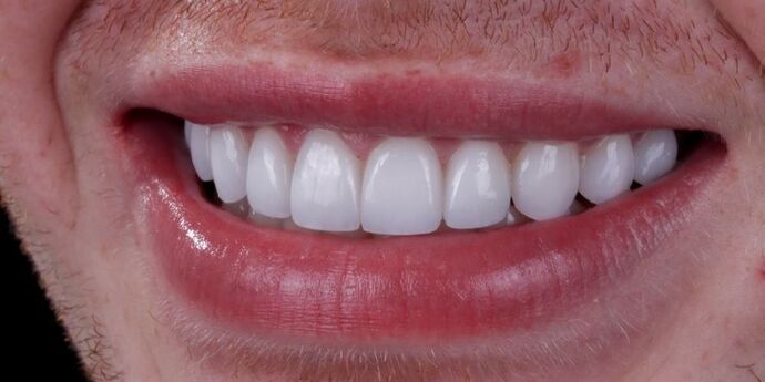 Smile Makeover & Veneers: Connor - After