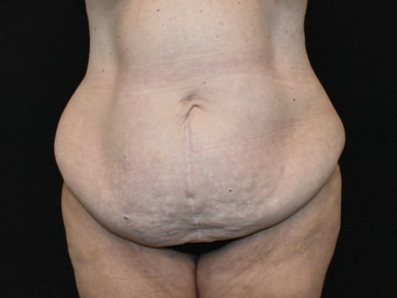 Abdominoplasty: Case 36 - Before