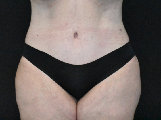 Abdominoplasty: Case 36 - After