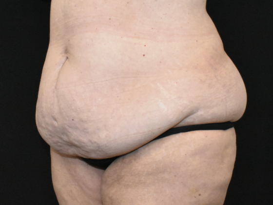 Abdominoplasty: Case 36 - Before