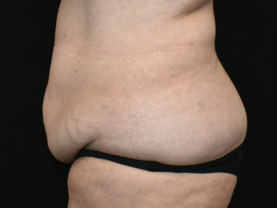 Abdominoplasty: Case 36 - Before