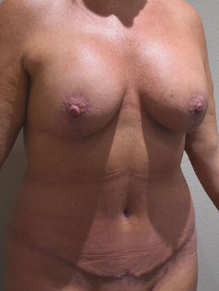 Massive Weight Loss : Case 197 - After