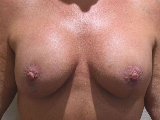 Breast Augmentation w/ Lift Case 632 - After