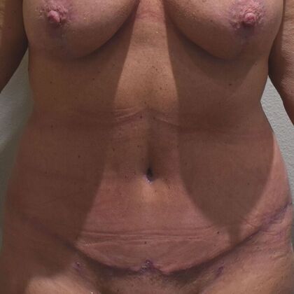 Tummy Tuck (Abdominoplasty): Case 566 - After