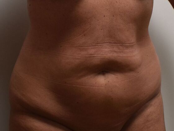 Tummy Tuck (Abdominoplasty): Case 566 - Before
