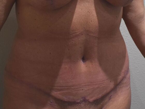 Tummy Tuck (Abdominoplasty): Case 566 - After