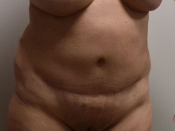 Tummy Tuck (Abdominoplasty): Case 567 - Before