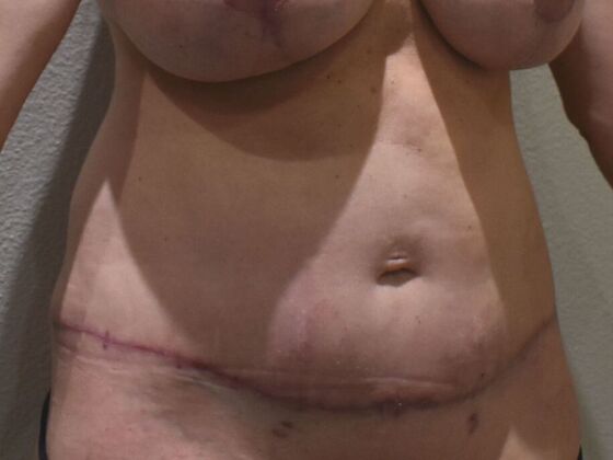 Tummy Tuck (Abdominoplasty): Case 569 - After