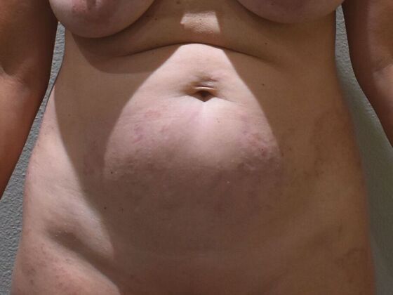 Tummy Tuck (Abdominoplasty): Case 569 - Before