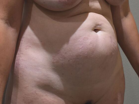 Tummy Tuck (Abdominoplasty): Case 569 - Before