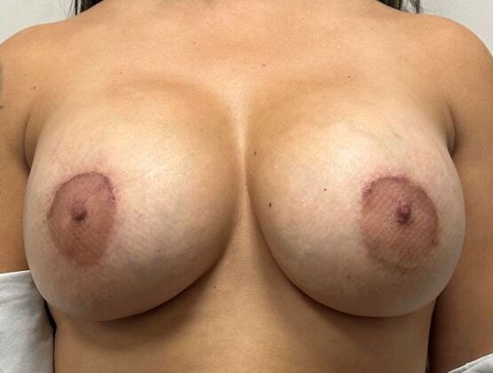 Breast Revision: Case 326 - After