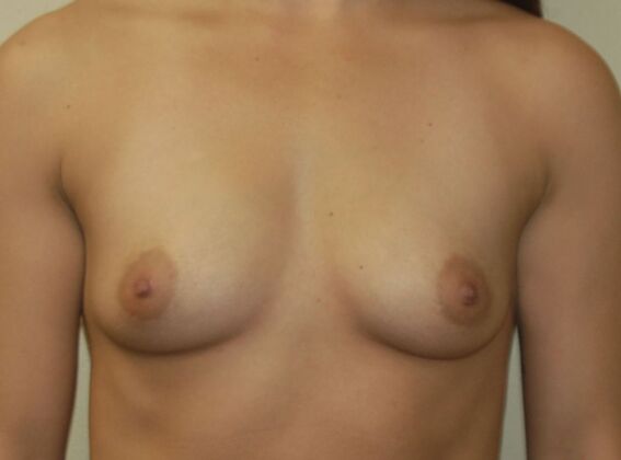 Breast Augmentation Case 793 - Before