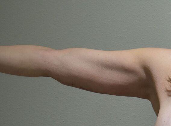 Brachioplasty Case 25 - After