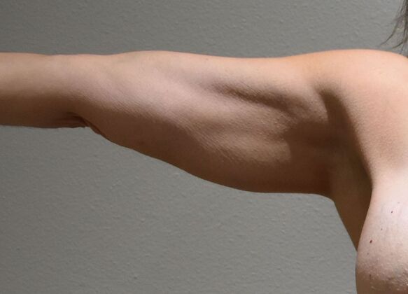 Brachioplasty Case 25 - Before