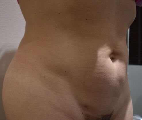 Tummy Tuck (Abdominoplasty): Case 570 - Before
