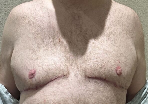 Gynecomastia: Case 8 - After