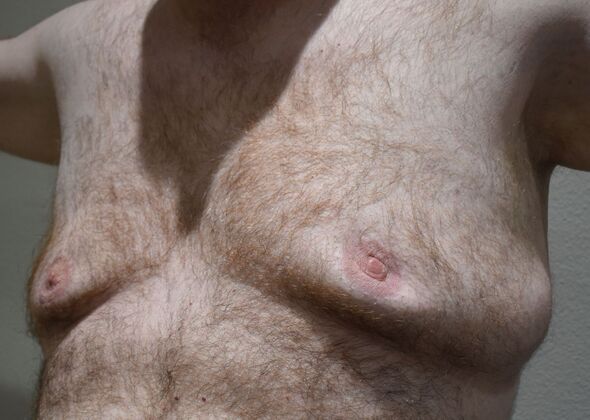 Gynecomastia: Case 8 - Before