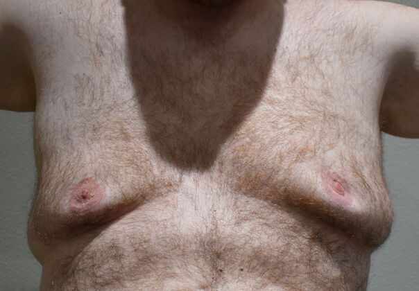 Gynecomastia: Case 8 - Before