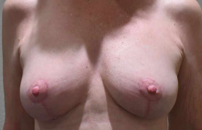 Breast Lift (Mastopexy) Case 252 - After