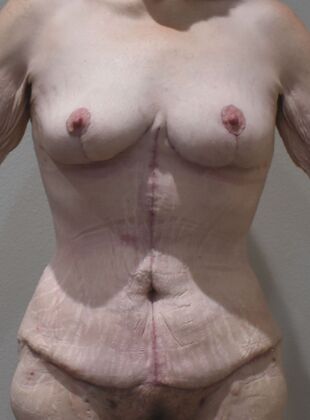 Massive Weight Loss : Case 198 - After