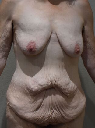 Massive Weight Loss : Case 198 - Before