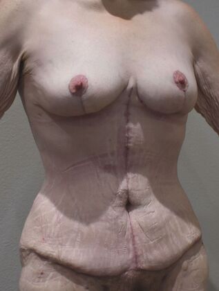 Mommy Makeover: Case 363 - After