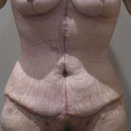 Tummy Tuck (Abdominoplasty) Case 571 - After