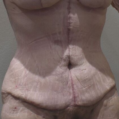 Tummy Tuck (Abdominoplasty): Case 571 - After