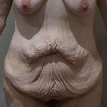 Tummy Tuck (Abdominoplasty) Case 571 - Before