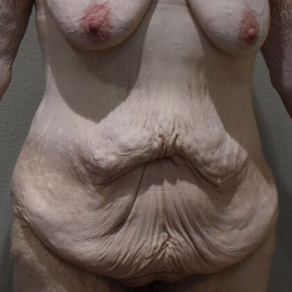 Tummy Tuck (Abdominoplasty): Case 571 - Before