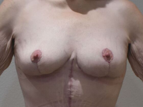 Breast Lift (Mastopexy) Case 257 - After