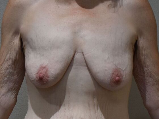 Breast Lift (Mastopexy) Case 257 - Before