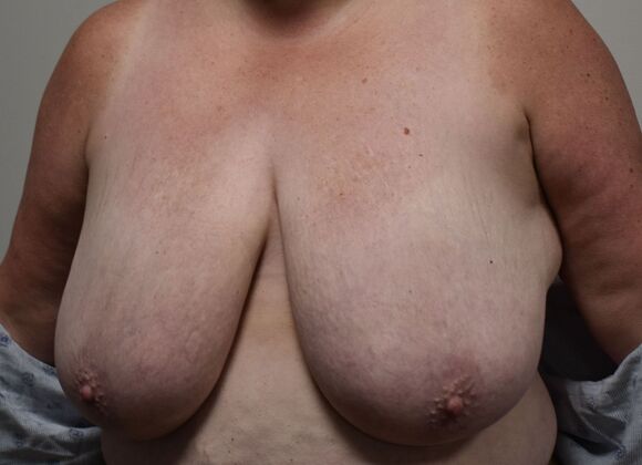 Breast Reduction: Case 205 - Before