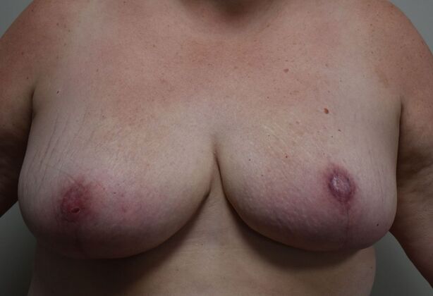 Breast Reduction: Case 205 - After