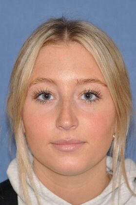 Rhinoplasty: Beautiful result in bump, crooked and blocked breathing - Before