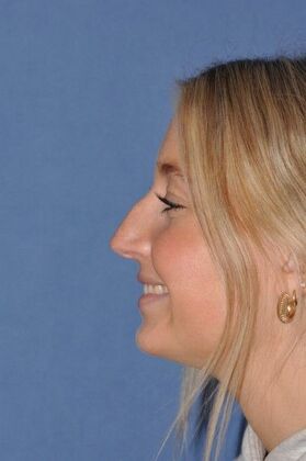 Rhinoplasty: Beautiful result in bump, crooked and blocked breathing - Before