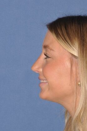 Rhinoplasty: Beautiful result in bump, crooked and blocked breathing - After