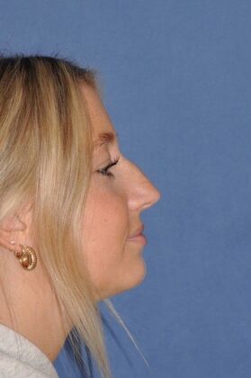 Rhinoplasty: Beautiful result in bump, crooked and blocked breathing - Before