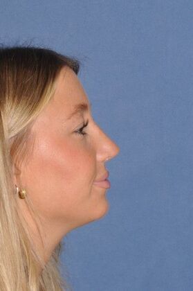 Rhinoplasty: Beautiful result in bump, crooked and blocked breathing - After